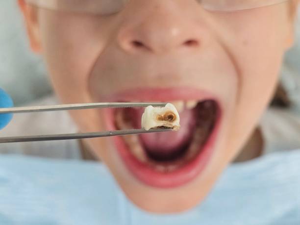 Best Emergency Treatment for Dental Infections or Abscesses in Rosenhayn, NJ